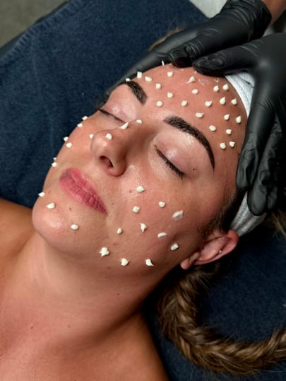 Liquid Microneedling