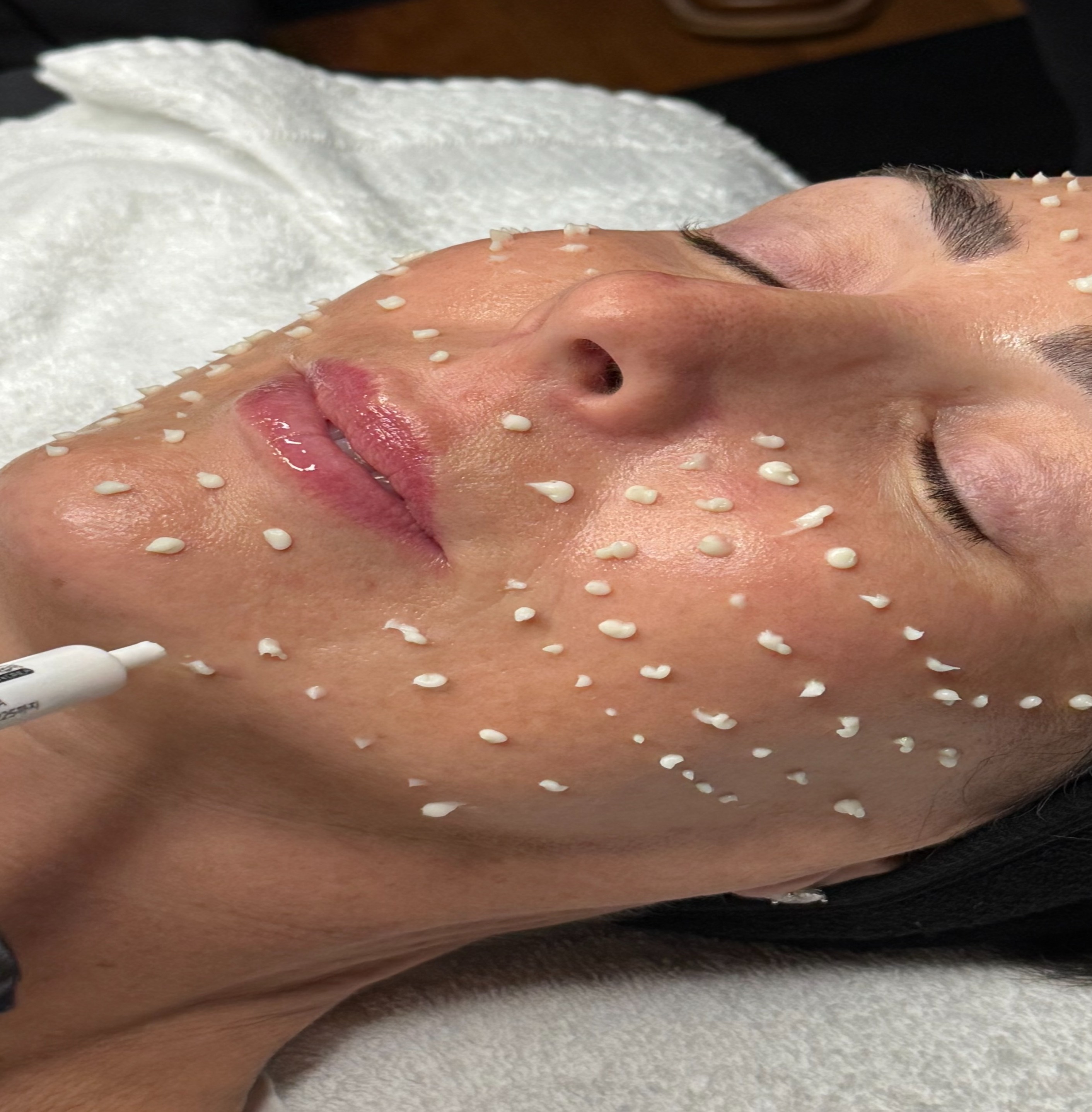 Liquid microneedling