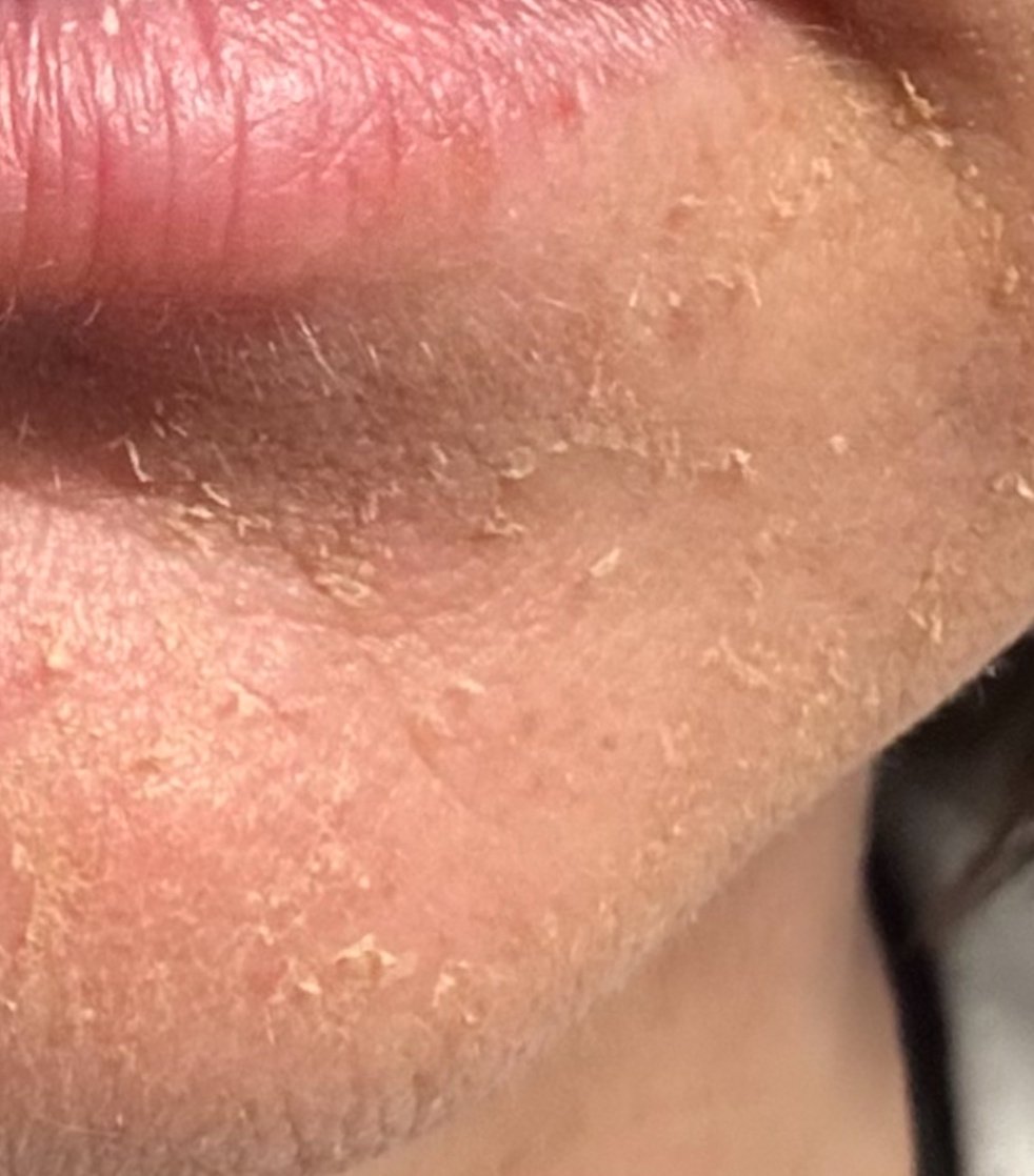 close up of chin and cheek peeling